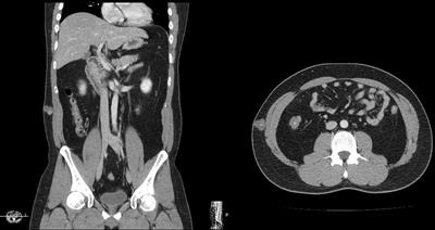 Next-generation sequencing study on poorly differentiated carcinoma derived from a thirty-year-old epidermoid cyst: A case report